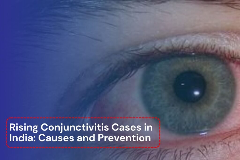 Rising Conjunctivitis Cases in India: Causes and Prevention
